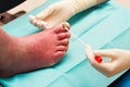 Treatment For Severe Fungal Nail Infection Royalty Free Stock Photo