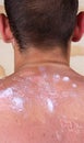 Treatment of severe sunburn Royalty Free Stock Photo