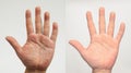 Before and after the treatment of skin diseases. Psoriasis. On the palm