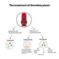 The treatment of thrombocytosis. Embolism. Infographics. Vector illustration on isolated background Royalty Free Stock Photo