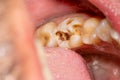 Treatment of tooth decay with subsequent filling with photopolymer material. Close-up, macro Royalty Free Stock Photo
