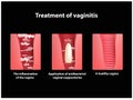 Treatment of vaginitis suppositories. inflammation the vagina. Infographics. vector illustration