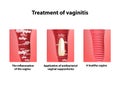 Treatment of vaginitis suppositories. inflammation the vagina. Infographics. vector illustration on background Royalty Free Stock Photo