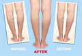 Treatment of varicose before and after. Varicose veins on the legs.