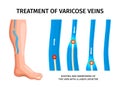 Treatment Of Varicose Veins Illustration Royalty Free Stock Photo