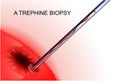 Trephine biopsy cancer tumor Royalty Free Stock Photo