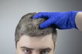 A trichologist examines a young manÃ¢â¬â¢s gray hair under a magnifying glass. Earlier bleaching of hair and pigment as a sign of low