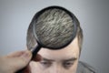 A trichologist examines a young manÃ¢â¬â¢s gray hair under a magnifying glass. Earlier bleaching of hair and pigment as a sign of low Royalty Free Stock Photo