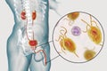 Trichomoniasis infection in man