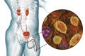 Trichomoniasis infection in man