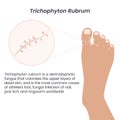 Trichophyton Rubrum fungus vector illustration graphic