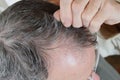 Trichotillomania, human impulse behavioral problem,hair pulling disorder