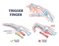 Trigger finger as finger stuck in bent position condition outline diagram Royalty Free Stock Photo
