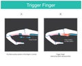 Trigger finger. illustration explain a symptom of locked finger caused by a problem with the tendon of human finger Royalty Free Stock Photo
