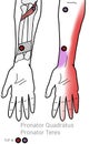 Pronator quadratus and Pronator teres myofascial trigger points are a possible source of your wrist, hand and lower arm pain