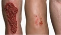 A trio of skin abrasions, each in a different stage of healing
