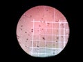 Triple phosphate crystals on urine test