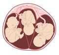 Triplets in utero from an anterior. three fetuses in the uterus. Multiple pregnancy. risk factor. Separate amniotic sacks, one Royalty Free Stock Photo