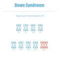 Trisomy of chromosome 21 Royalty Free Stock Photo