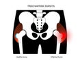 Bursitis inflammation concept Royalty Free Stock Photo