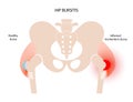 Bursitis inflammation concept