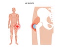 Bursitis inflammation concept