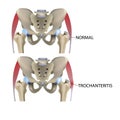 Trochanteritis, femoral tendon inflammation, femoral tendon diseases, vector medical illustration