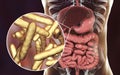 Tropheryma whipplei bacteria in human duodenum, the causative organism of Whipple& x27;s disease