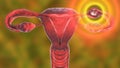 Tubal ectopic pregnancy, 3D illustration