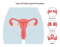 Tubal ligation surgery. Permanent birth control procedure types. Tubes blockage Royalty Free Stock Photo