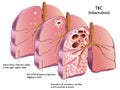 Tuberculosis