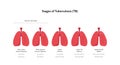 Tuberculosis disease concept. Vector flat healthcare illustration. Stages of tb infected lung isolated on white background. Design