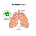 Tuberculosis. Lung disease. Tubercle bacillus. Vector illustration on isolated background