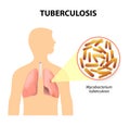 Tuberculosis, MTB or TB