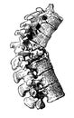 Tuberculosis of the spine bones, close-up.