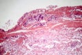 Tuberculous pleurisy, light micrograph