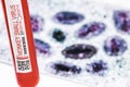 Tubes for blood collection with monkeypox contaminated blood, photo of variola virus in the background, epidemic control