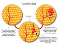 Tumor cells