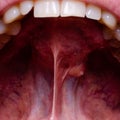 A tumor in the oral cavity of an adult, closeup. dental problems