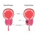 Tumor in prostate gland