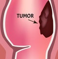 A tumor in the rectum. The structure of the rectum of the intestine. Types of polyps and tumors in the colon