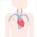 Tunneled central line venous catheter medical diagram