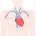 Tunneled central line venous catheter medical diagram