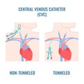 Central line venous catheter types on male body