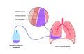 Tunneled pleural catheter Royalty Free Stock Photo