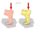 Turf toe. Rupture of the plantar plate of the first toe of the f