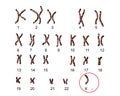 Turner s-syndrome karyotype