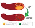 Turning high level of atherosclerotic plaque in blood vessel into normal level