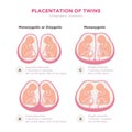 Twin types infographic elements in flat design. Monozygotic or Dizygotic Placentation of twins medical illustration and Royalty Free Stock Photo