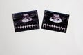 Twins ultrasonography embryos of 18 weeks